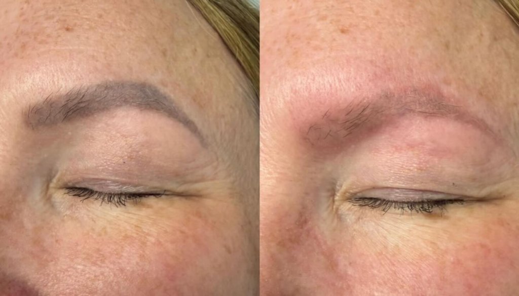 Victoria Tattoo Removal (Formally New Skin Laser Tattoo Removal)
